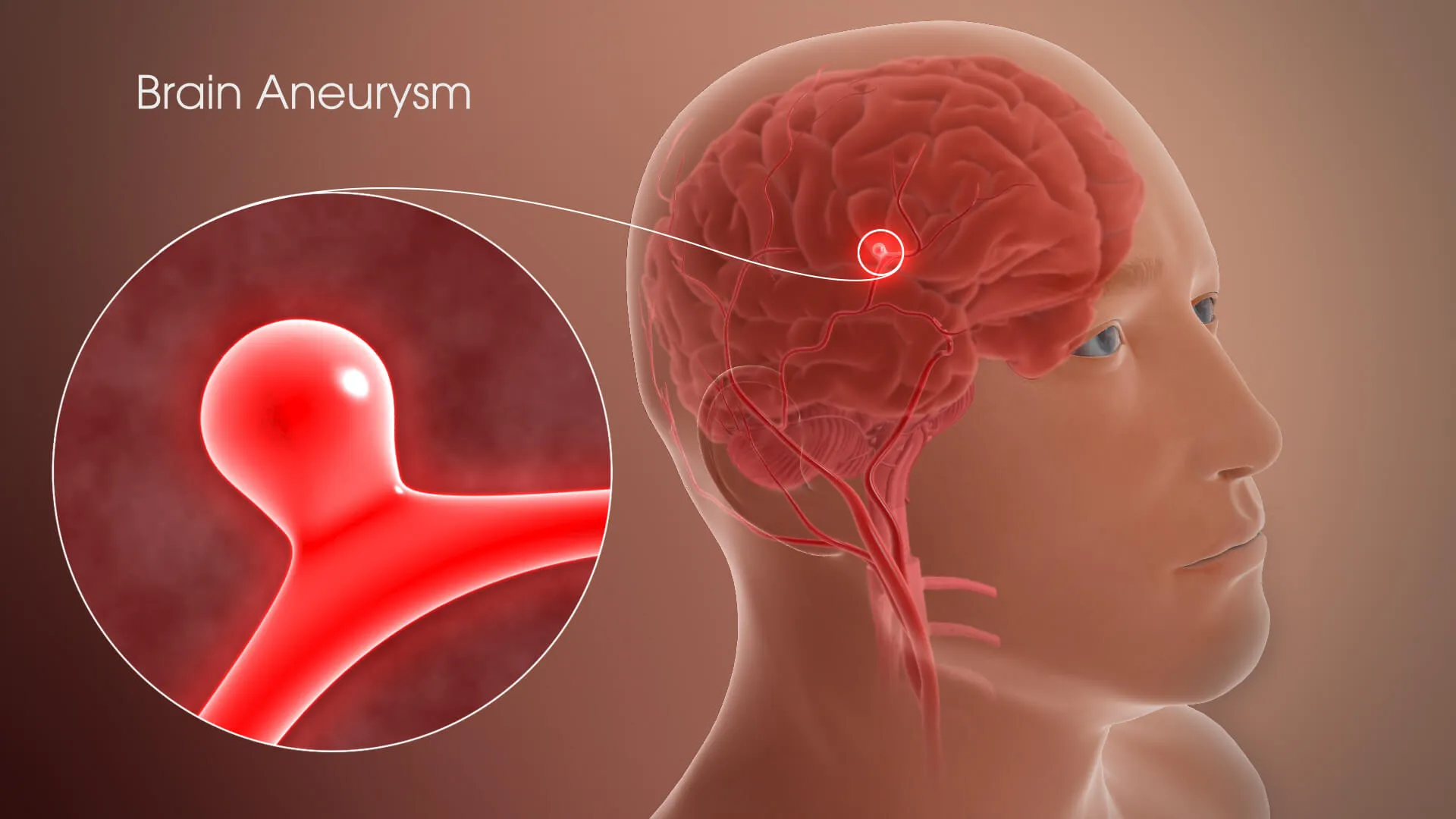 Brain Aneurysm