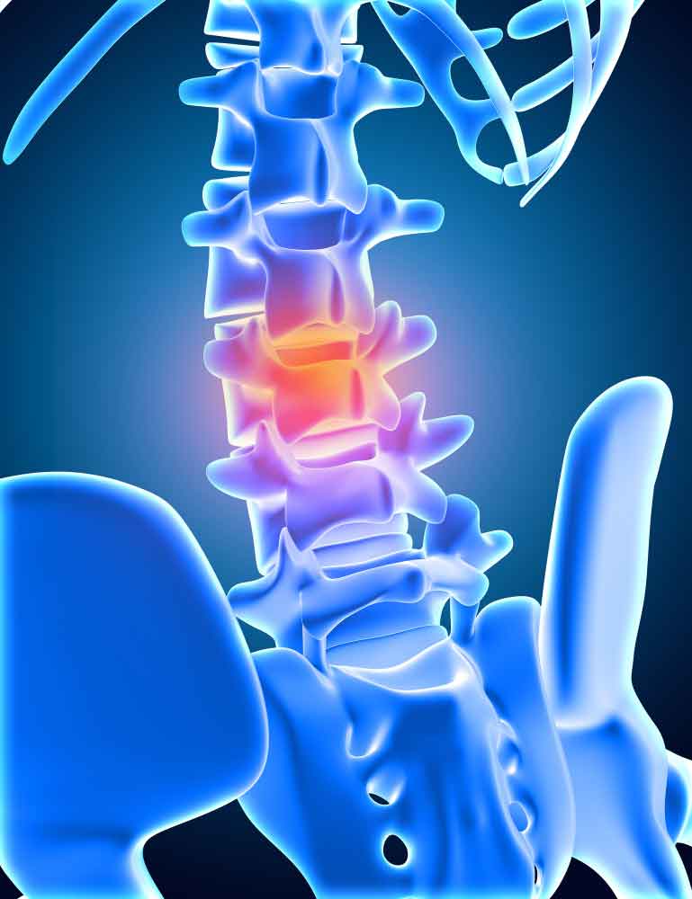 Foraminotomy